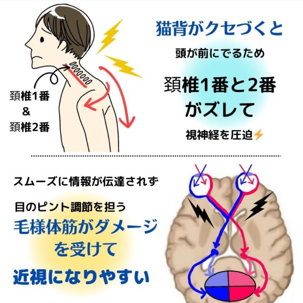 猫背は視力が低下する
